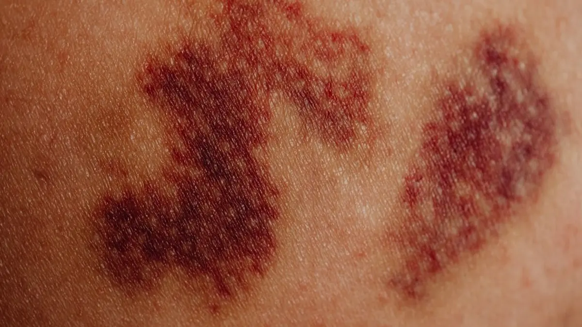 Hémorroïde externe : 5 signes visuels pour l'identifier